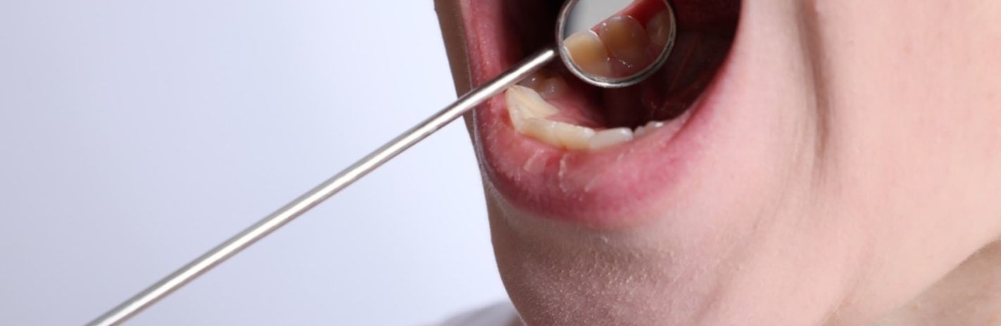 Greyholme Dental_Oral Cancer