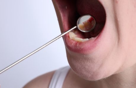 Early Detection Saves Lives During Mouth Cancer Action Month
